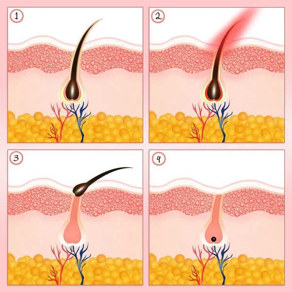 Remoção de cabelo — Fotografia de Stock