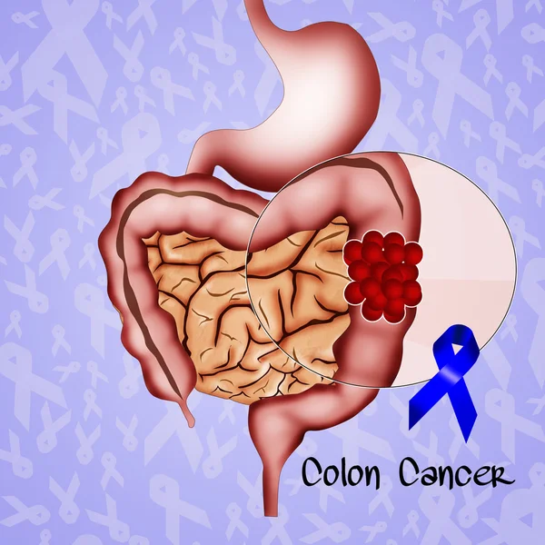 Cáncer de colon — Foto de Stock