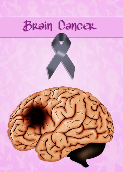 Рак мозку — стокове фото