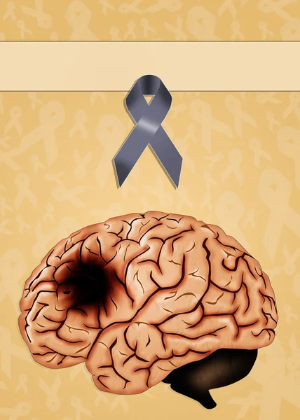 Rak mózgu — Zdjęcie stockowe