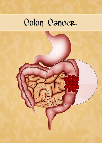 Cáncer de colon — Foto de Stock