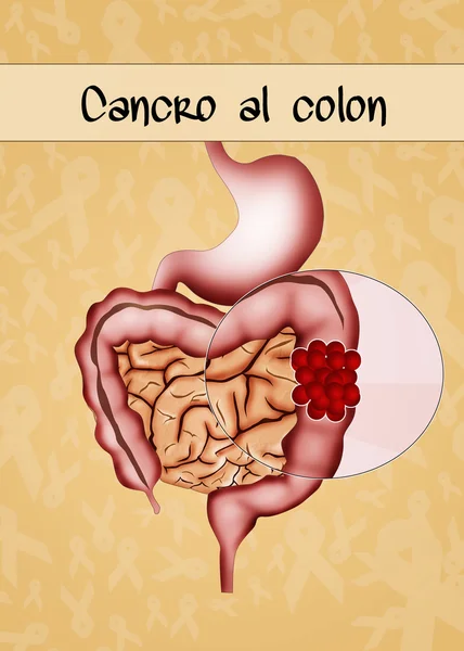 Cáncer de colon — Foto de Stock