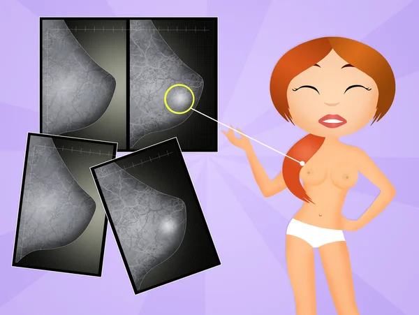 Mammografie — Stockfoto