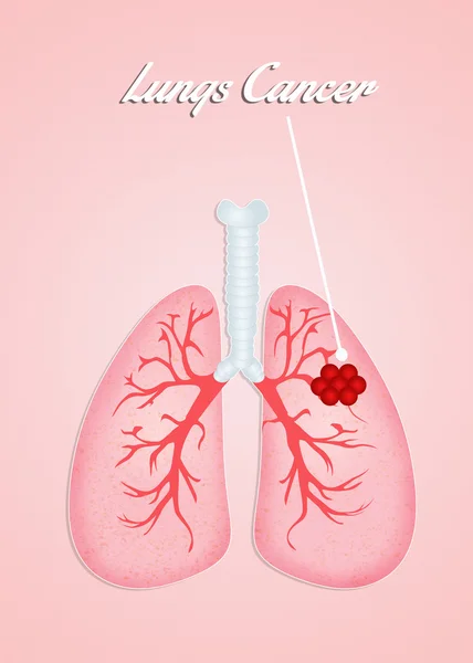 Lungs cancer — Stock Photo, Image