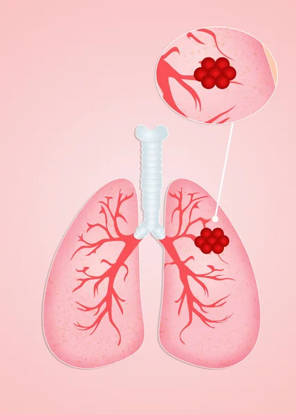 Rak płuc — Zdjęcie stockowe