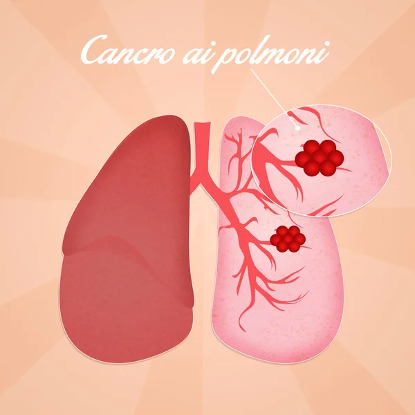 Cáncer de pulmón — Foto de Stock