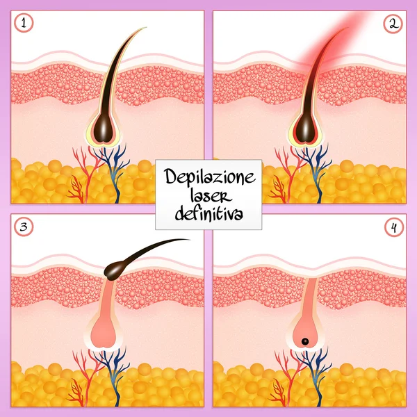 Trwałe usunięcie włosów — Zdjęcie stockowe