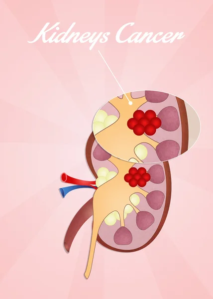 Cáncer renal — Foto de Stock