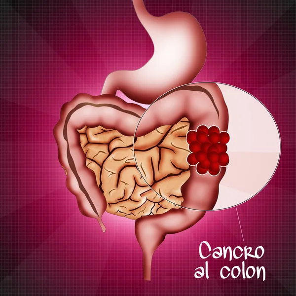 Cáncer intestinal — Foto de Stock