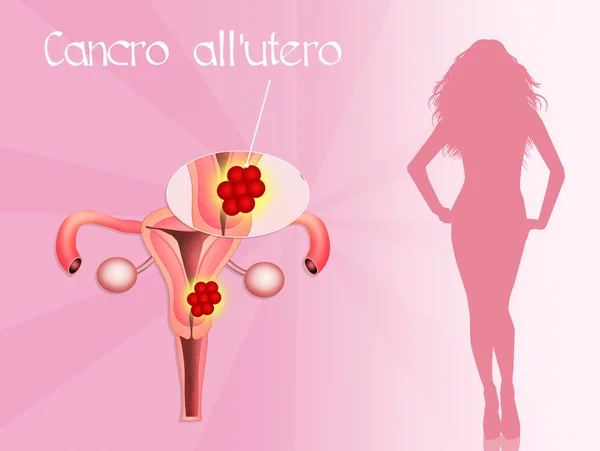 Cáncer uterino — Foto de Stock