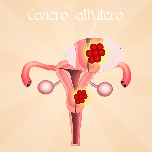 Cancro uterino — Foto Stock