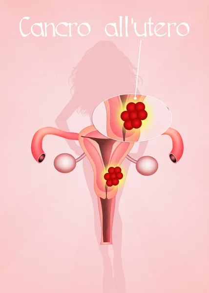 Cancro uterino — Foto Stock
