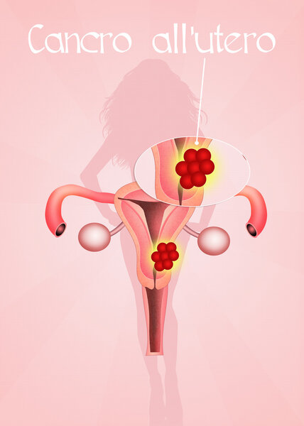 Uterine Cancer