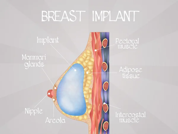 Emlő implantátum diagram — Stock Fotó