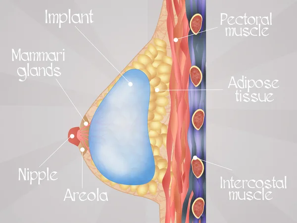 Diagrama del implante mamario —  Fotos de Stock