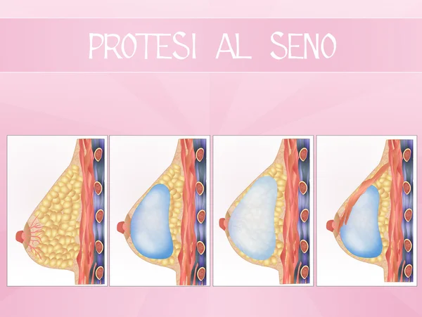 Protesi mammarie — Foto Stock