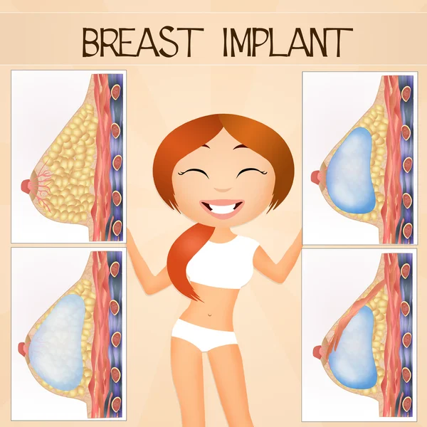 Implantes mamários — Fotografia de Stock