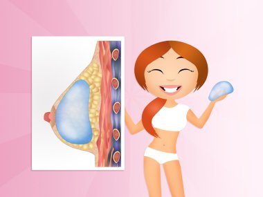 Göğüs implantları