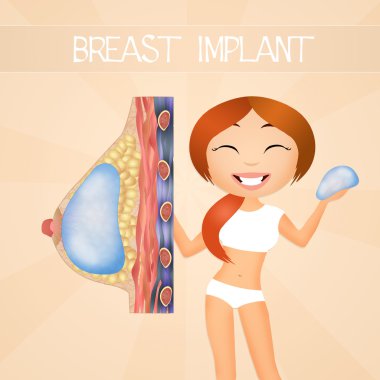Göğüs implantları