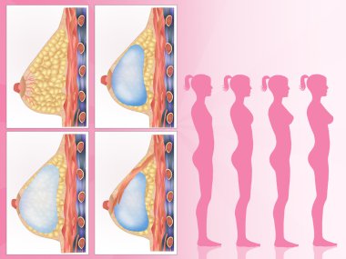 Göğüs implantları