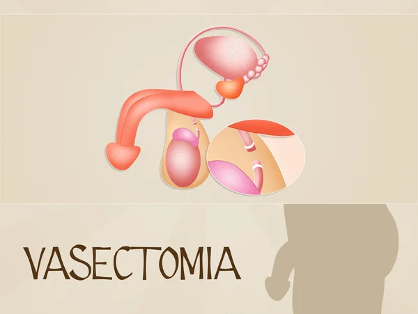 Vasectomy — Φωτογραφία Αρχείου