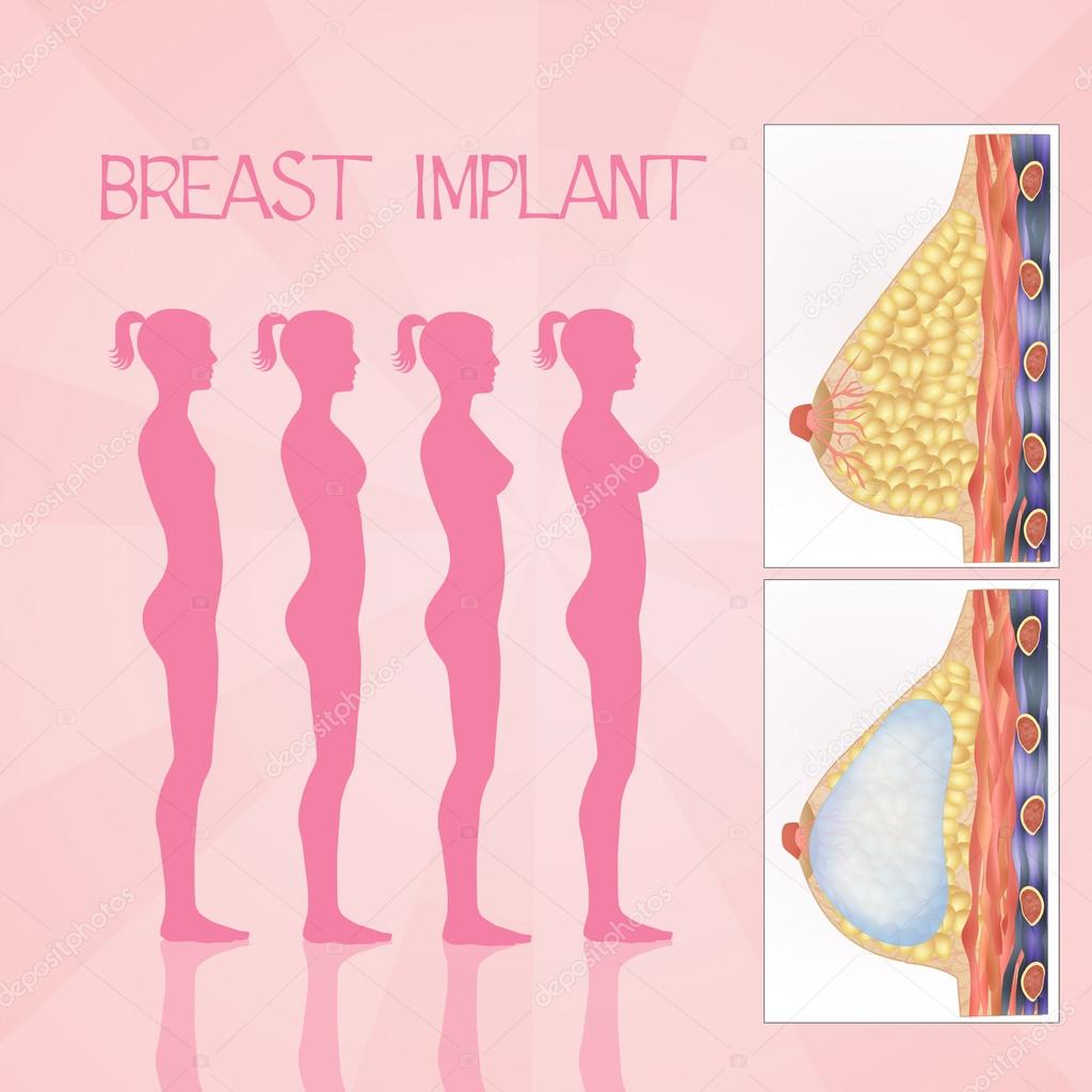 Breast implants