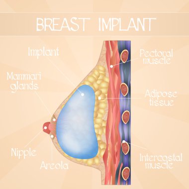 Göğüs implantları