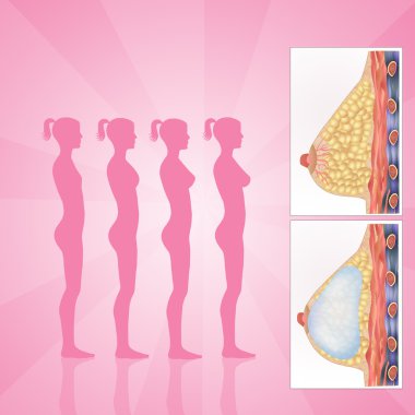Göğüs implantları