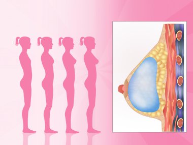 Göğüs implantları