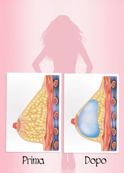 Antes y después de la cirugía mamaria — Foto de Stock