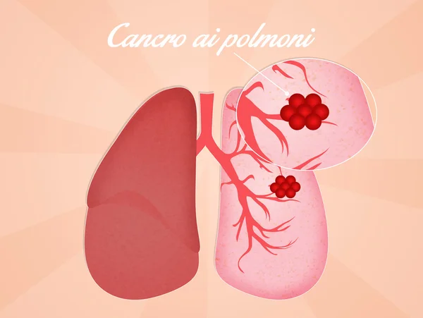Tüdő rák — Stock Fotó