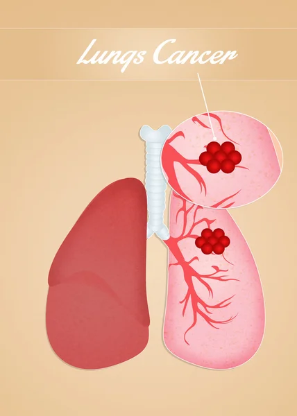 Rak płuc — Zdjęcie stockowe