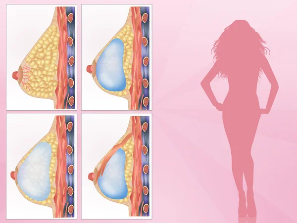 Женщины выбирают грудные импланты — стоковое фото