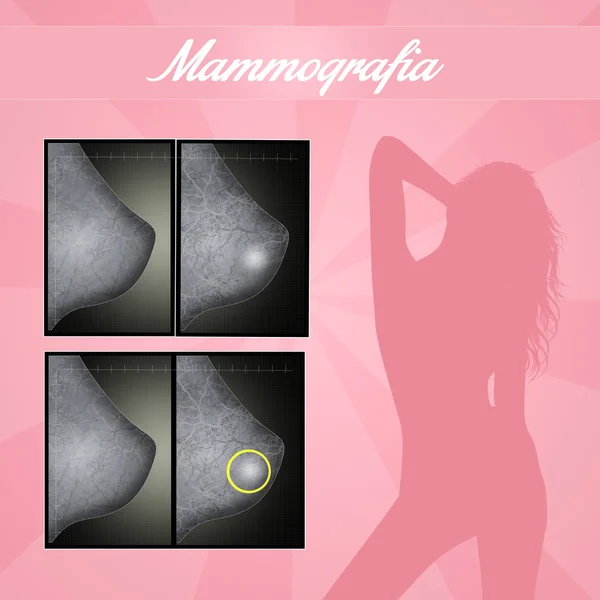 Kvinnan gör mammografi — Stockfoto