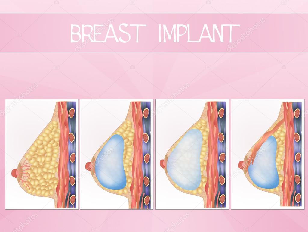 Breast implants