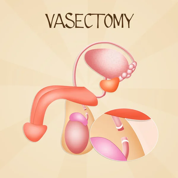 Vasectomie — Fotografie, imagine de stoc