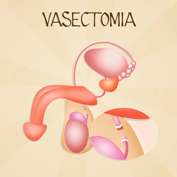 Vasectomie — Stockfoto