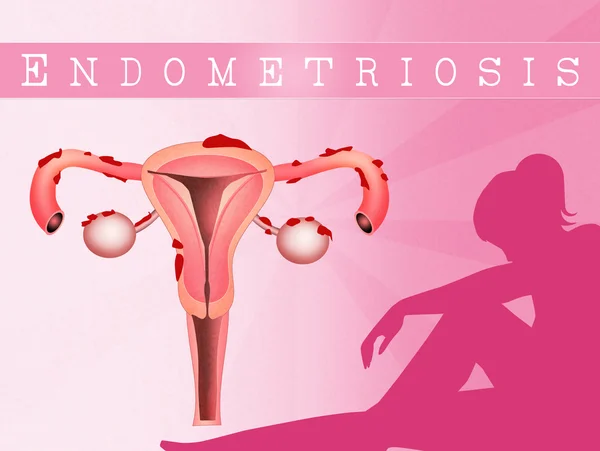 Endometriosis — Foto de Stock
