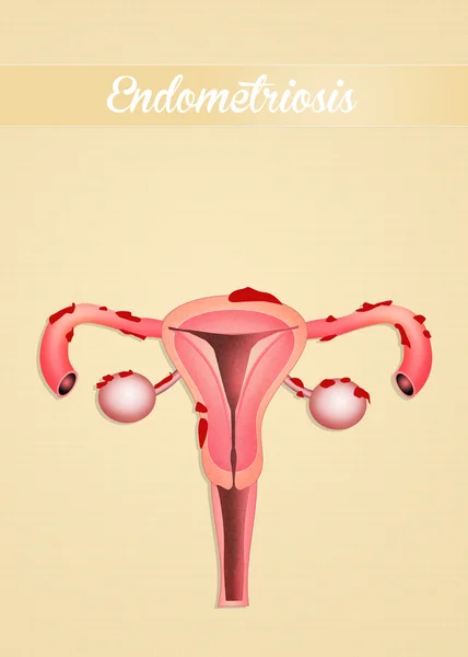 Endometriose — Stockfoto