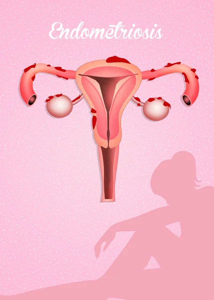 Malattia da endometriosi — Foto Stock