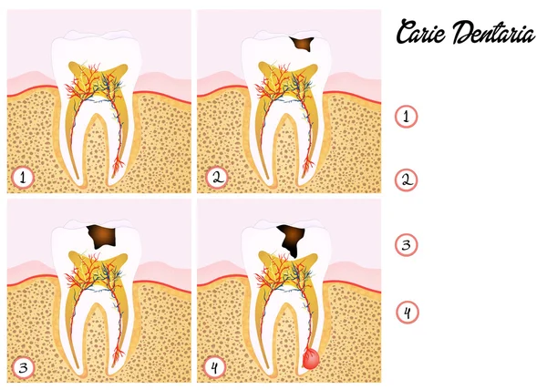 Tooth decay — Stock Photo, Image