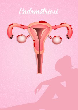 endometriozis hastalığı düzeni