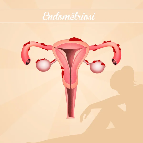 Endometriose ziekte illustratie — Stockfoto