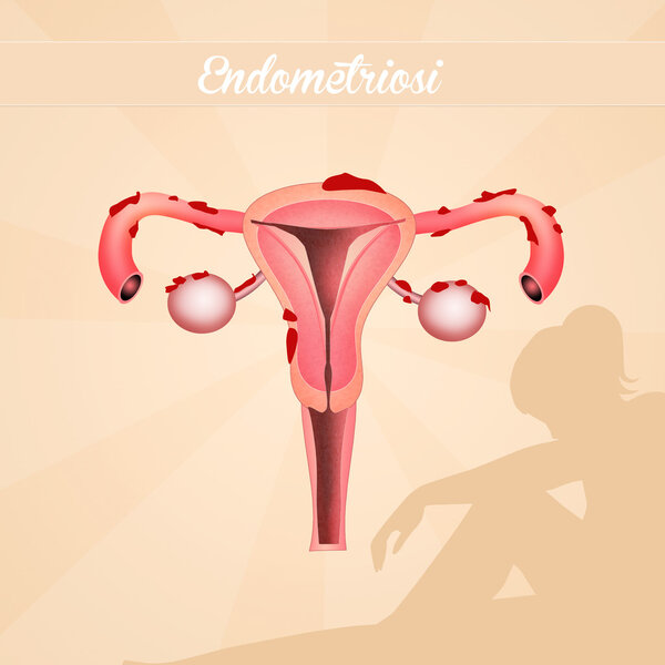 endometriosis disease illustration