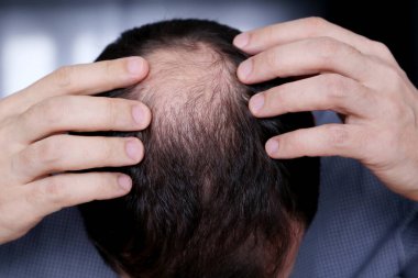 Kellik, saç dökülmesinden endişelenen adam. Kel kafalı bir erkek.