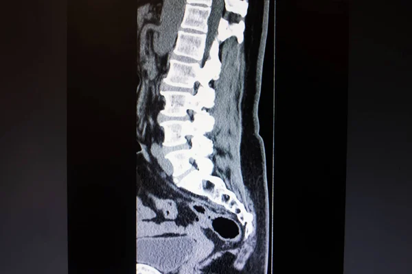 颈椎闭合的计算机断层扫描图像 — 图库照片