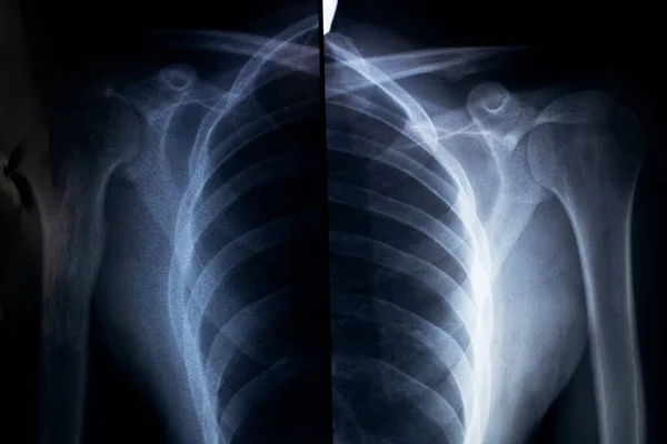 两边肩部的X光拍得很近 — 图库照片