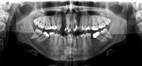 Röntgenbild des menschlichen Mundes — Stockfoto
