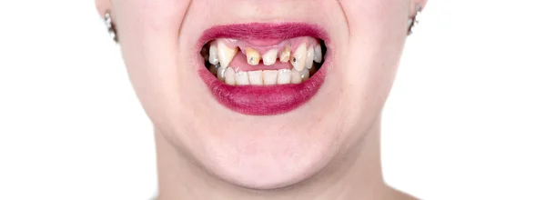 Sonrisa de mujer sin dientes delanteros — Foto de Stock