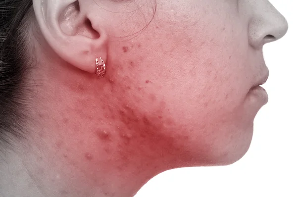 kadın var onu cilt sorunları